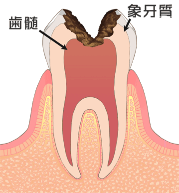 C3（歯髄炎）