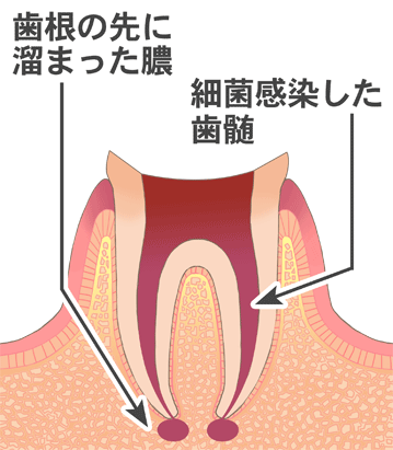 C3（根尖性歯周炎）