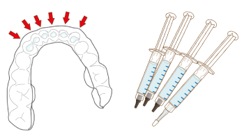 次回、ご来院時に出来上がったマウスピースとお家で行っていただくホワイトニング用の薬剤をお渡しいたします。（約14回分）