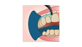 歯茎にホワイトニングの材料が流れないように歯と歯茎の境目に歯ぐきを保護する材料を盛っていきます。