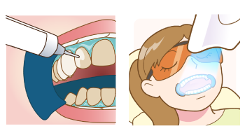 ホワイトニングの材料を歯に塗布し、光を当てていきます。（２回）