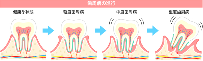 歯周病の進行