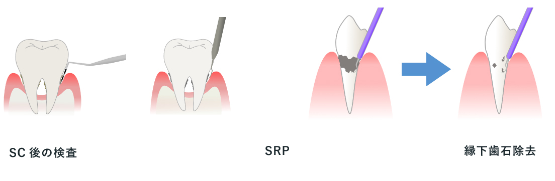 歯石とりが終わった後の歯茎の状態とSRP